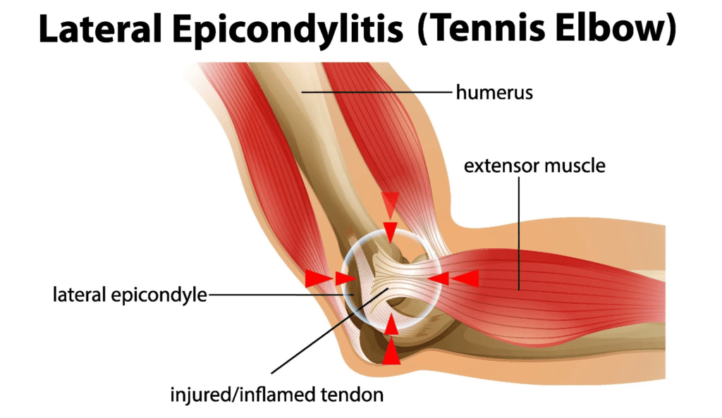 Tennis Elbow Exercises